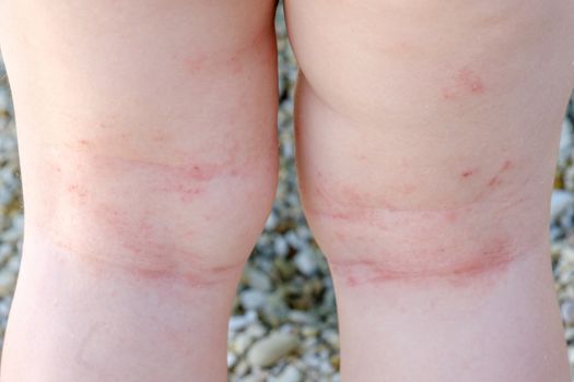 skin irritation newborn closeup atopic dermatitis legs scratches
