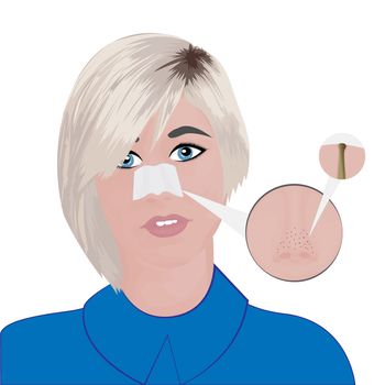 Treatment Blackheads on Nose vector illustration showing skin problems