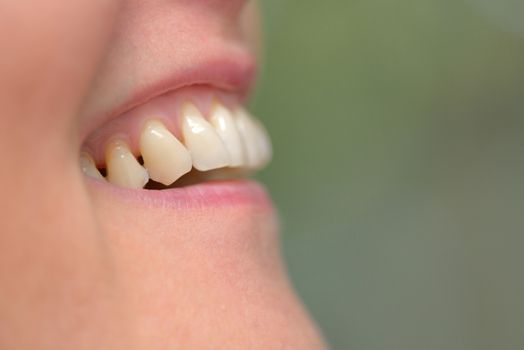 Detail of woman teeth parodontose