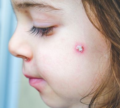 chicken pox spot details face close up spots baby face side cheek .