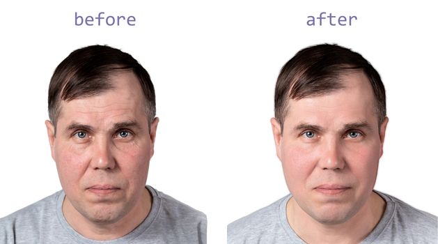 Face of a mature man before and after cosmetic rejuvenating procedures, isolated on white background.