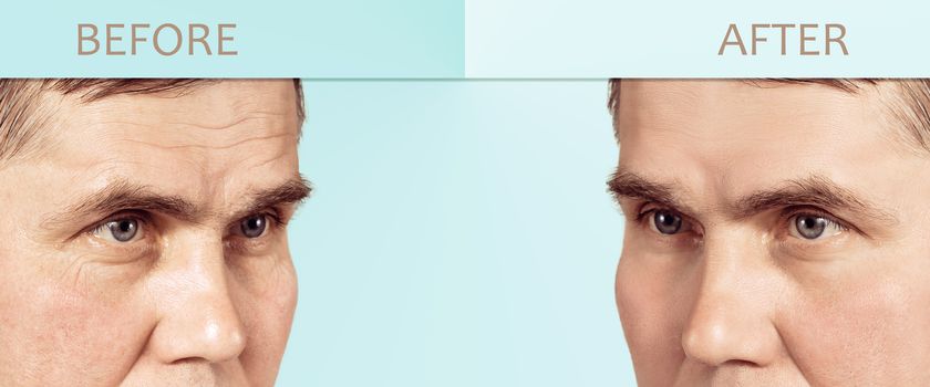 Face of a mature man before and after cosmetic rejuvenating procedures, with copy space in the center.