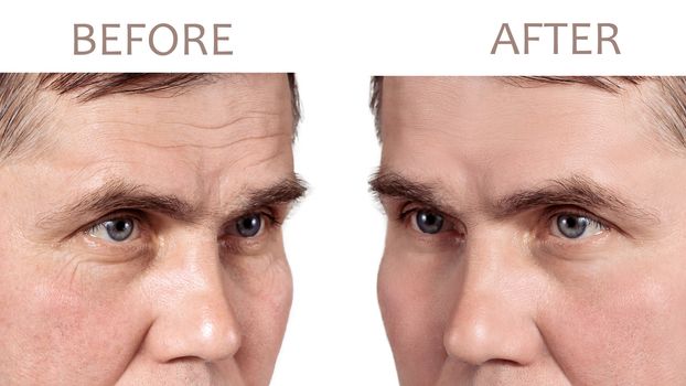 Face of a mature man before and after cosmetic rejuvenating procedures.