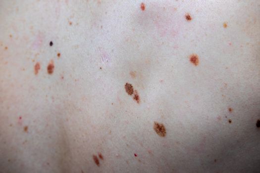 A melanocytic nevus also known as nevocytic , nevus-cell and commonly as a mole is a type of tumor that contains nevus cells.