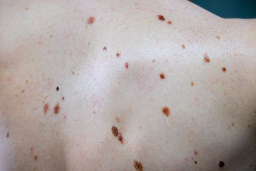A melanocytic nevus also known as nevocytic , nevus-cell and commonly as a mole is a type of tumor that contains nevus cells.