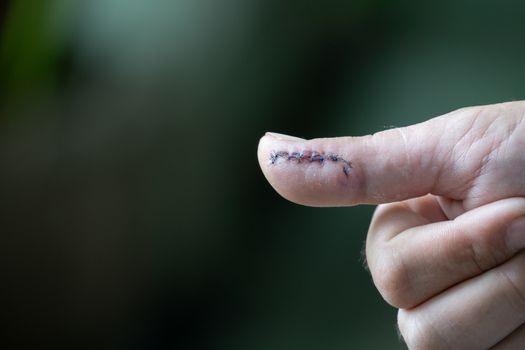 hand with stitches from surgery to repair damage