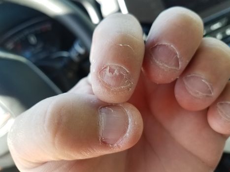 nasty disgusting bitten and peeling fingernails in car or automobile