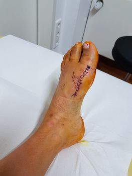 Foot with bloody stings after hallux operation at the first postoperative examination at the doctor for orthopedic surgery