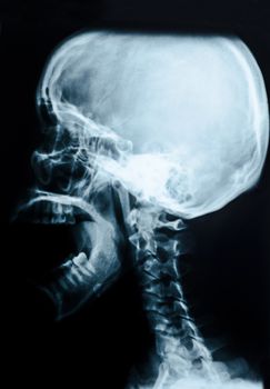 Film x-ray skull and cervical spine lateral view.