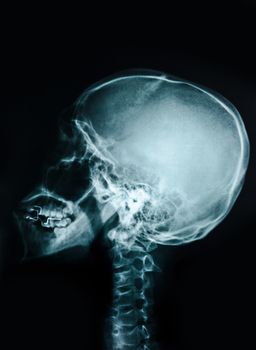 Film x-ray skull and cervical spine lateral view