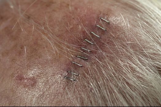 Medical staples close up scalp incision created while extracting a squamous cell carcinoma using the Mohs surgical technique. Another squamous cell site to be treated is seen to the lower left of the first incision.