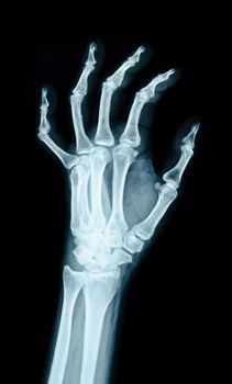 X-ray image of the hand on black background.