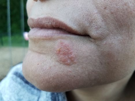 red itchy rash or sore and blister on woman's chin and face