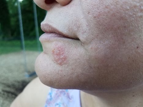 red itchy rash or sore and blister on woman's chin and face