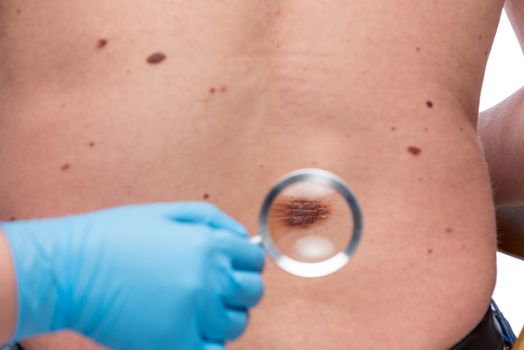 Dermatologist examining the skin on the back of a patient