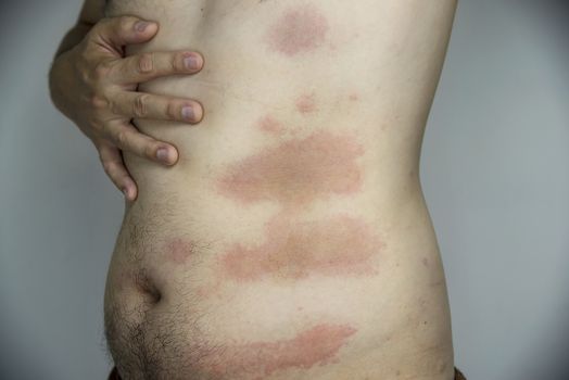 Man getting red skin rash at his body part - people with skin allergy problem concept