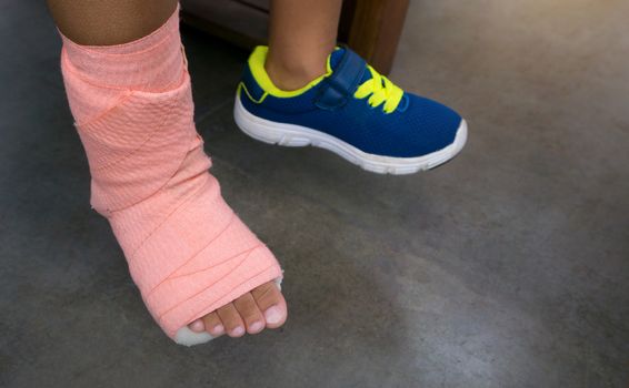 Children wearing a splint of leg broken from injury.