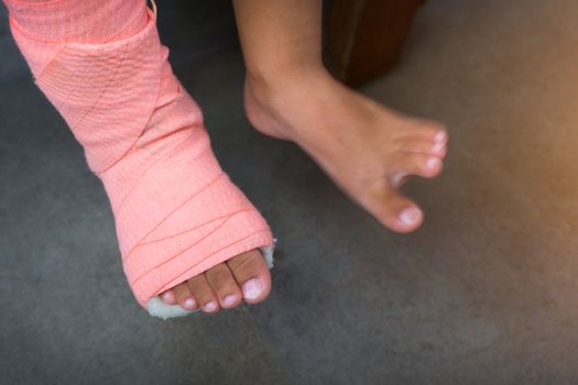 Children wearing a splint of leg broken from injury.