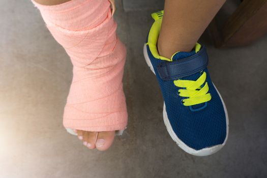 Children wearing a splint of leg broken from injury.