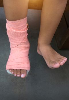 Children wearing a splint of leg broken from injury.