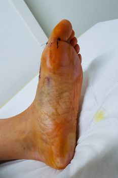 Foot with bloody stings after hallux operation at the first postoperative examination at the doctor for orthopedic surgery