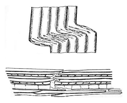 Compression fracture, vintage engraved illustration.
