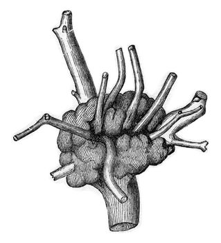 Magnifier produced on Quercus Cerris, at the insertion of an already old foot Loranthus installs parasite., vintage engraved illustration.
