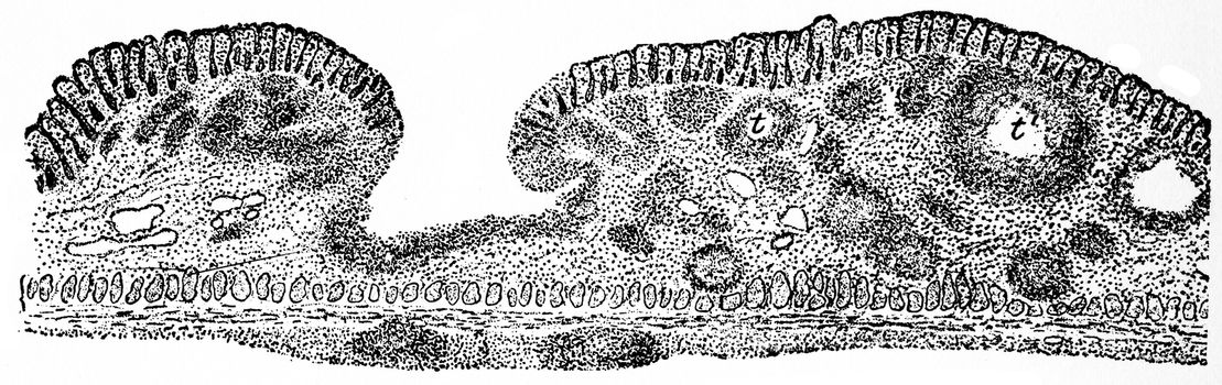 Tubercular ulcer, vintage engraved illustration.
