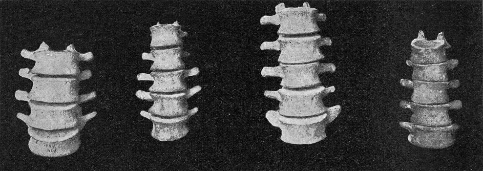 Comparative table of lumbar vertebral columns of a European, an Australian, an African negro and a Dwarf negro of the Philippines, vintage engraved illustration. From the Universe and Humanity, 1910.
