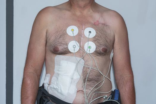 Naked upper body of a man with electrodes for measuring the heart tension curve for an electrocardiogram, ECG. Cable into the abdominal cavity of a left ventricular assist device.