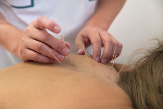Acupuncture needles on back of a young woman