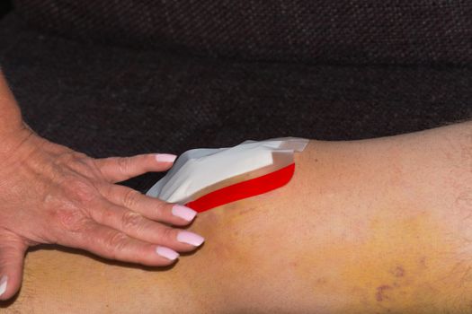 Male knee after surgical operation, knee replacement. Knee surgery in the hospital