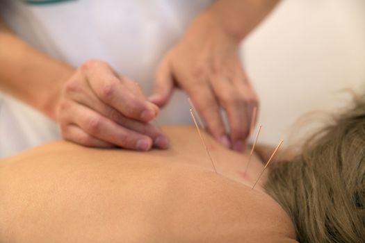 Acupuncture needles on back of a young woman