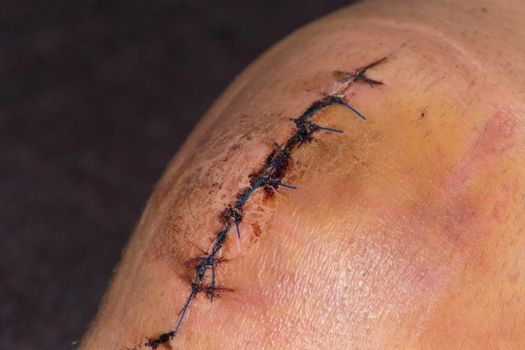 Male knee after surgical operation, knee replacement. Knee surgery in the hospital
