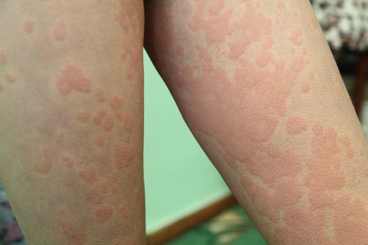 allergic dermatitis. The skin of the girl's legs is amazed by dermatitis