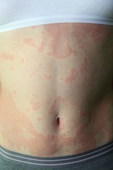 allergic dermatitis. The skin of the girl is amazed by dermatitis