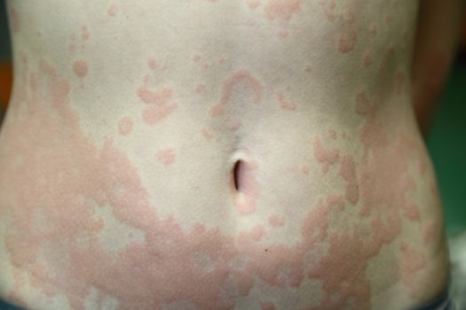 allergic dermatitis. The skin of the girl is amazed by dermatitis