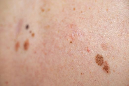 A melanocytic nevus also known as nevocytic or nevus-cell nevus and commonly as a mole is a type of melanocytic tumor