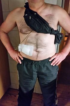 Man with auxiliary devices, artificial heart, LVAD, left or right ventricular assist device, controller batteries and power supply cable.