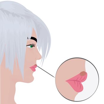 Herpes cold sores on woman's  lips vector illustration on a white background isolated