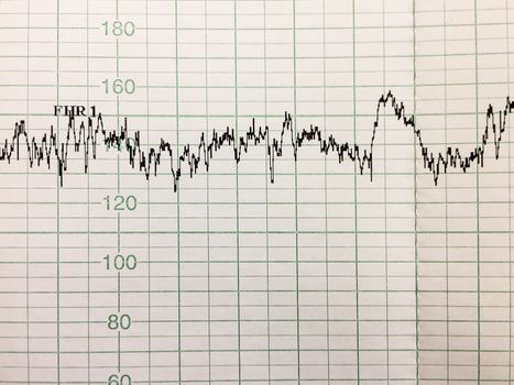 Printing of cardiogram report, electrocardiography, close-up