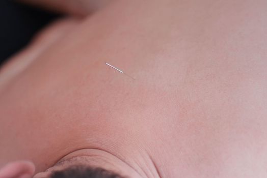 Body care , stimulating an acupuncture needle on the back of a patient.Acupuncture, is used to relieve pain or for medicinal purposes. The benefits of acupuncture.