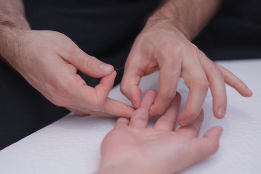 Body care , stimulating an acupuncture needle on the hand of a patient.Acupuncture, is used to relieve pain or for medicinal purposes. The benefits of acupuncture.