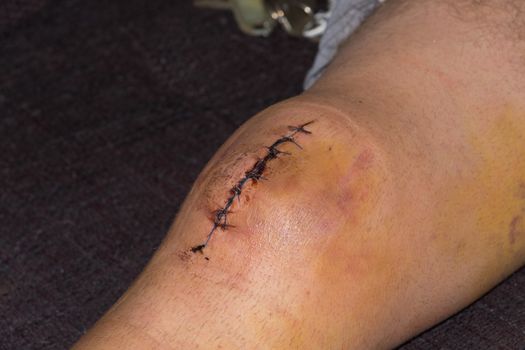 Male knee after surgical operation, knee replacement. Knee surgery in the hospital
