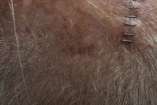 View of 65 year old male's scalp with squamous cell carcinoma site (horizontal) at center along hariline. Site is approx 3/4" across, 1/4" high. Subsequent Mohs surgery at site was successful in clearing the affected area. Vertical row of staples to right of center are closing incision from previous successful Mohs surgery on another squamous cell site. 