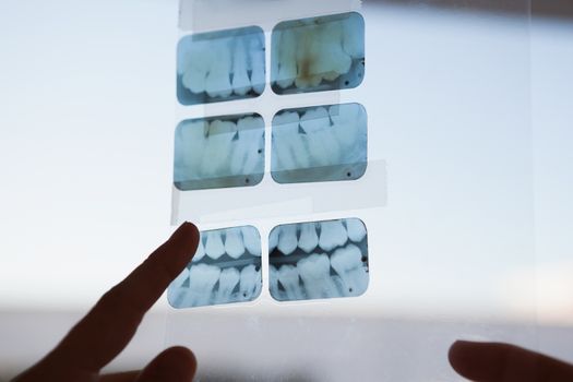 Dentists looking and pointing to xray at the dental clinic