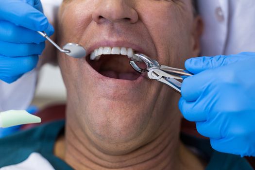 Dentist using surgical pliers to remove a decaying tooth in clinic