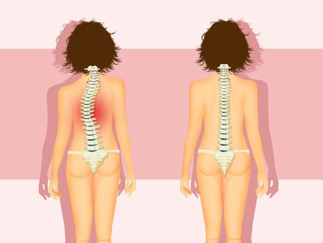 illustration of woman with scoliosis problem