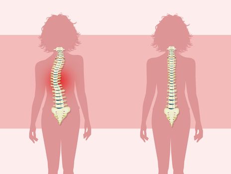 illustration of woman with scoliosis problem