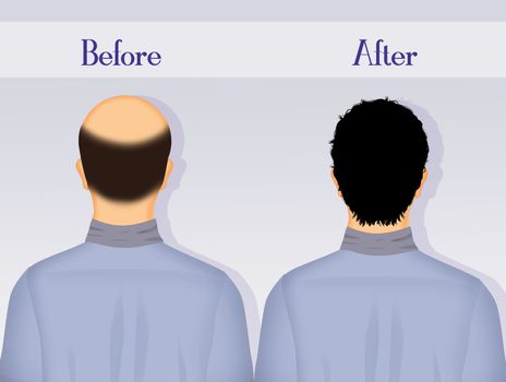 illustration of before and after hair transplantation